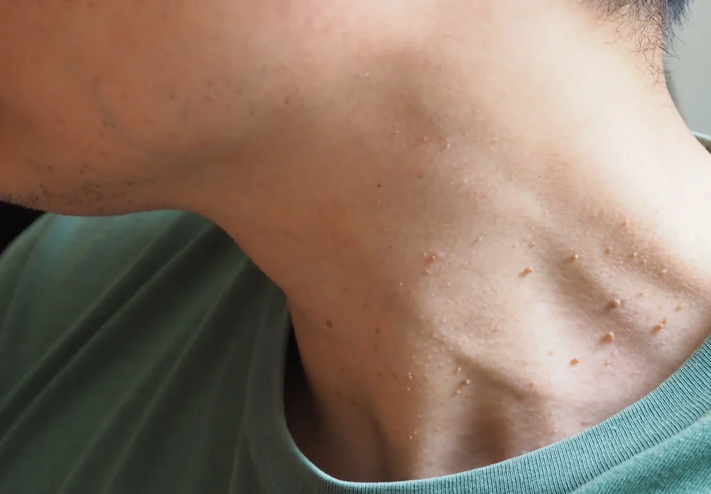 Skin Tag Removal: What to Know About Professional Treatment Options